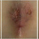 Illustration for article titled Cara Menghilangkan Kutil Di Kemaluan, Vagina, Anus, Penis Tumbuh Kutil